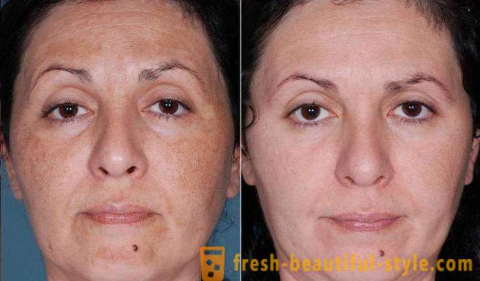 Киселина пилинг за лице: рецензије, фотографије пре и после