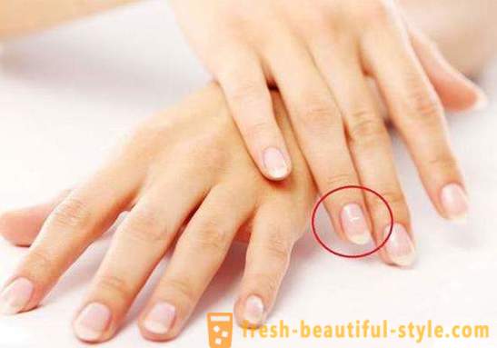 Беле мрље на ноктима прстију: узроцима и лечењу